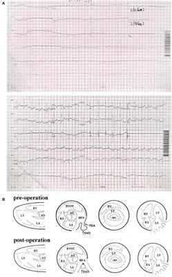 Case Report: BAF-Opathies/SSRIDDs Due to a de novo ACTL6A Variant, Previously Considered to Be Heart-Hand Syndrome